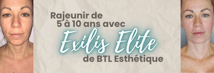 Rajeunir de 5 à 10 ans avec Exilis Elite! - 53 Karat